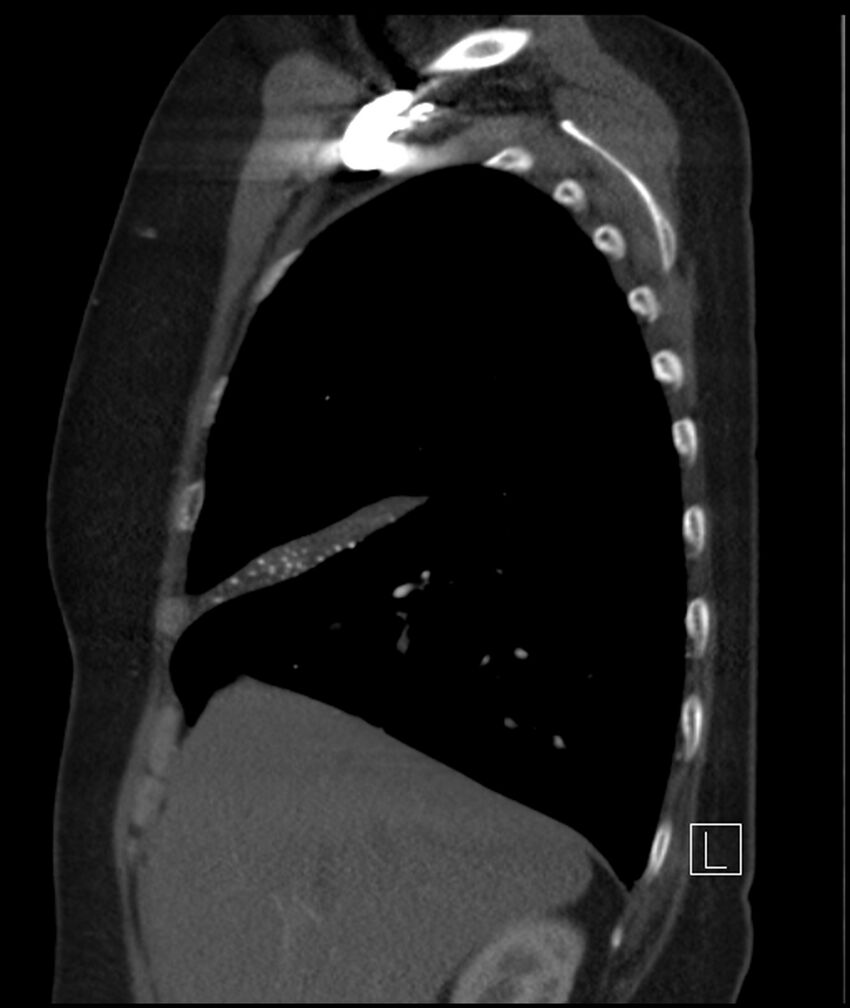 Adenocarcinoma of the lung (Radiopaedia 44205-47803 Sagittal C+ portal venous phase 42).jpg