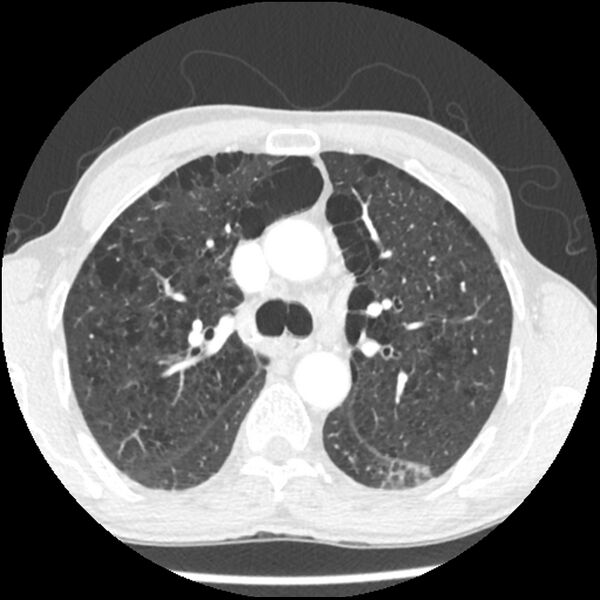 File:Adenocarcinoma of the lung - micropapillary predominant (Radiopaedia 42446-45563 C 9).jpg