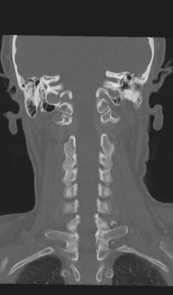 File:Adenoid cystic tumor of palate (Radiopaedia 46980-51518 Coronal bone window 44).png