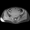 Adenomyoma of the uterus (huge) (Radiopaedia 9870-10438 Axial T1 fat sat 18).jpg