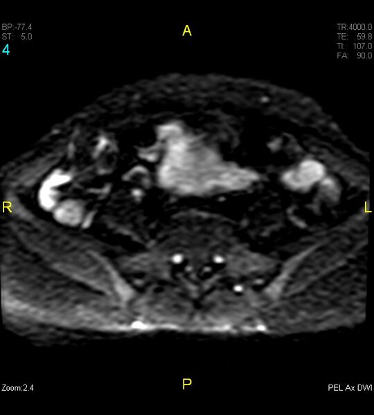 File:Adenomyosis (Radiopaedia 43504-46889 Axial DWI 4).jpg