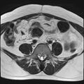 Adenomyosis - ovarian endometriomas (Radiopaedia 67031-76350 Axial T2 3).jpg