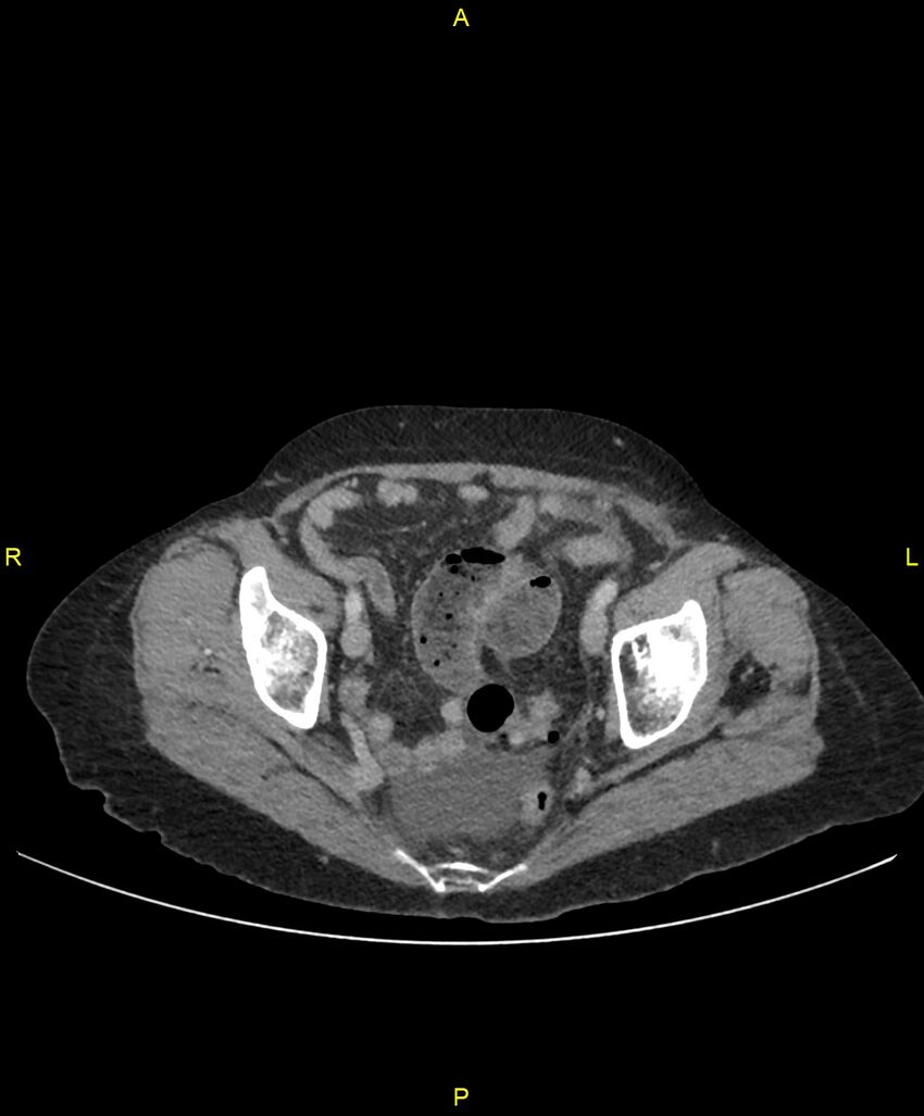 Adhesional small bowel obstruction (Radiopaedia 85402-101024 Axial C+ portal venous phase 248).jpg