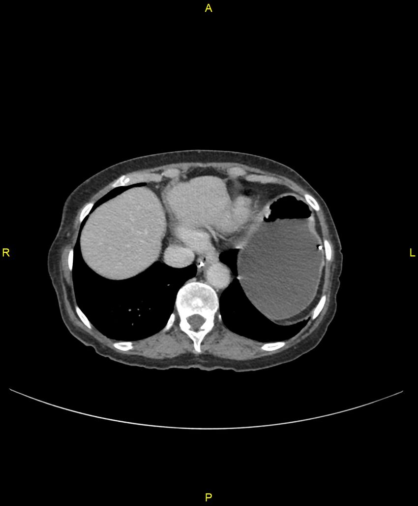 Adhesional small bowel obstruction (Radiopaedia 85402-101024 Axial C+ portal venous phase 33).jpg