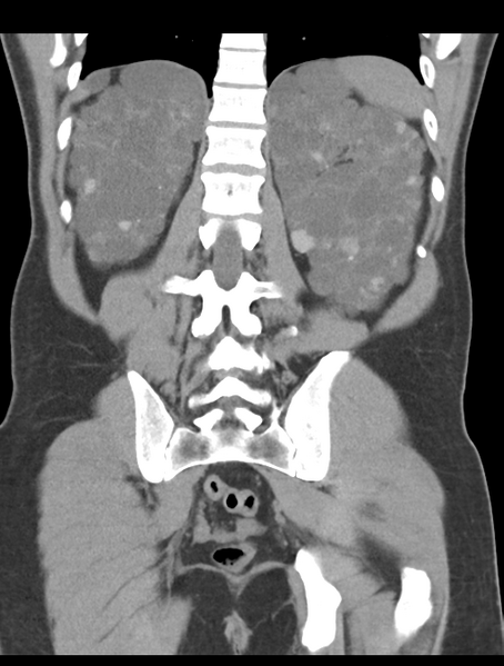 File:Adult polycystic kidney disease (Radiopaedia 47866-52626 Coronal non-contrast 38).png