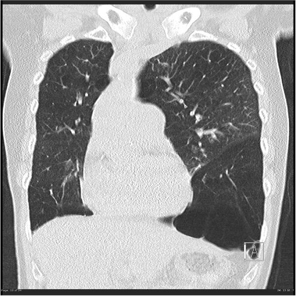 File:Alpha-1-antitrypsin deficiency (Radiopaedia 26537-26678 Coronal lung window 10).jpg