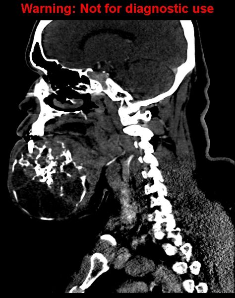 File:Ameloblastoma (Radiopaedia 33126-34164 F 32).jpg