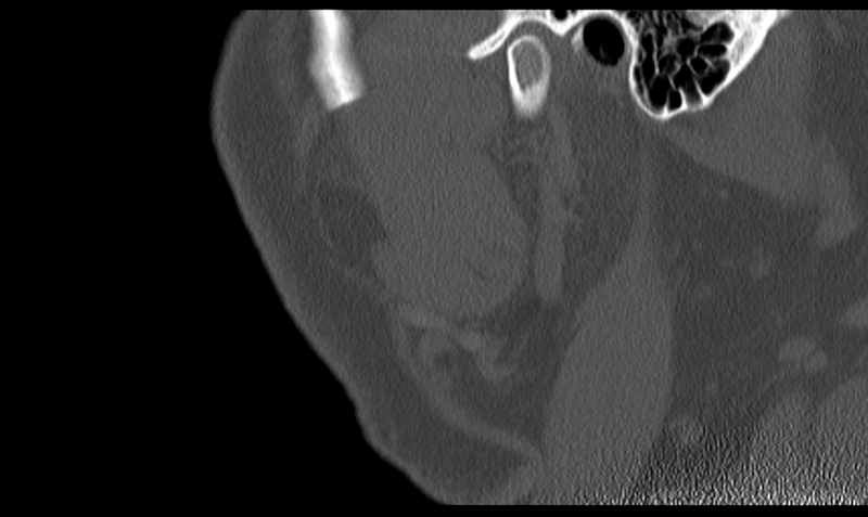 File:Ameloblastoma (Radiopaedia 33677-34806 Sagittal bone window 52).png