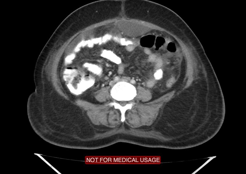 File:Amoebic enterocolitis with liver abscess (Radiopaedia 35100-36609 A 51).jpg