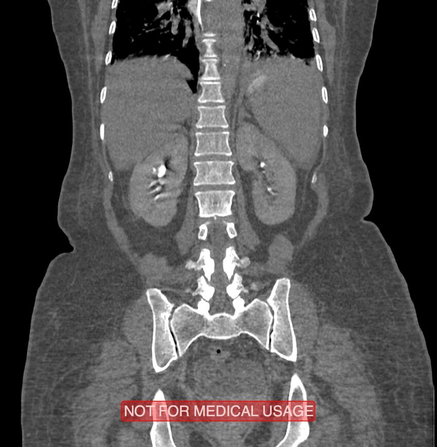 Amoebic enterocolitis with liver abscess (Radiopaedia 35100-36609 B 144).jpg