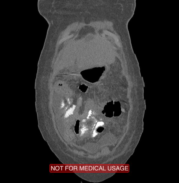 File:Amoebic enterocolitis with liver abscess (Radiopaedia 35100-36609 B 7).jpg