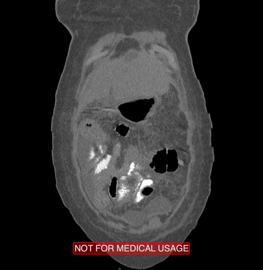 Amoebic enterocolitis with liver abscess (Radiopaedia 35100-36609 B 7).jpg