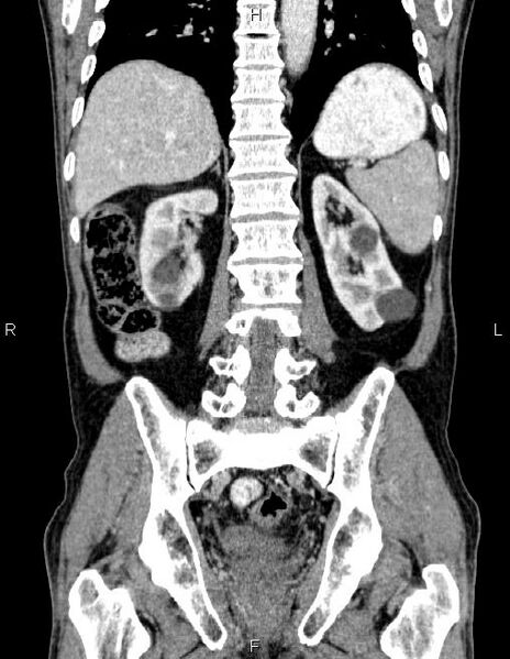 File:Ampullary adenocarcinoma (Radiopaedia 86093-102032 C 47).jpg