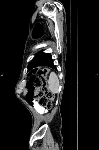 File:Ampullary adenocarcinoma (Radiopaedia 86093-102033 E 86).jpg