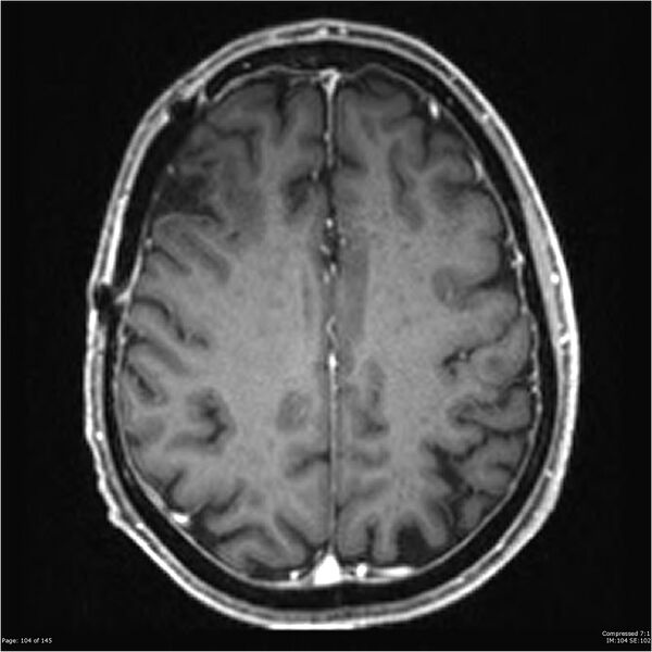 File:Anaplastic meningioma with recurrence (Radiopaedia 34452-35788 Axial T1 C+ 104).jpg