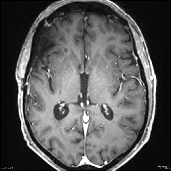 File:Anaplastic meningioma with recurrence (Radiopaedia 34452-35788 Axial T1 C+ 73).jpg