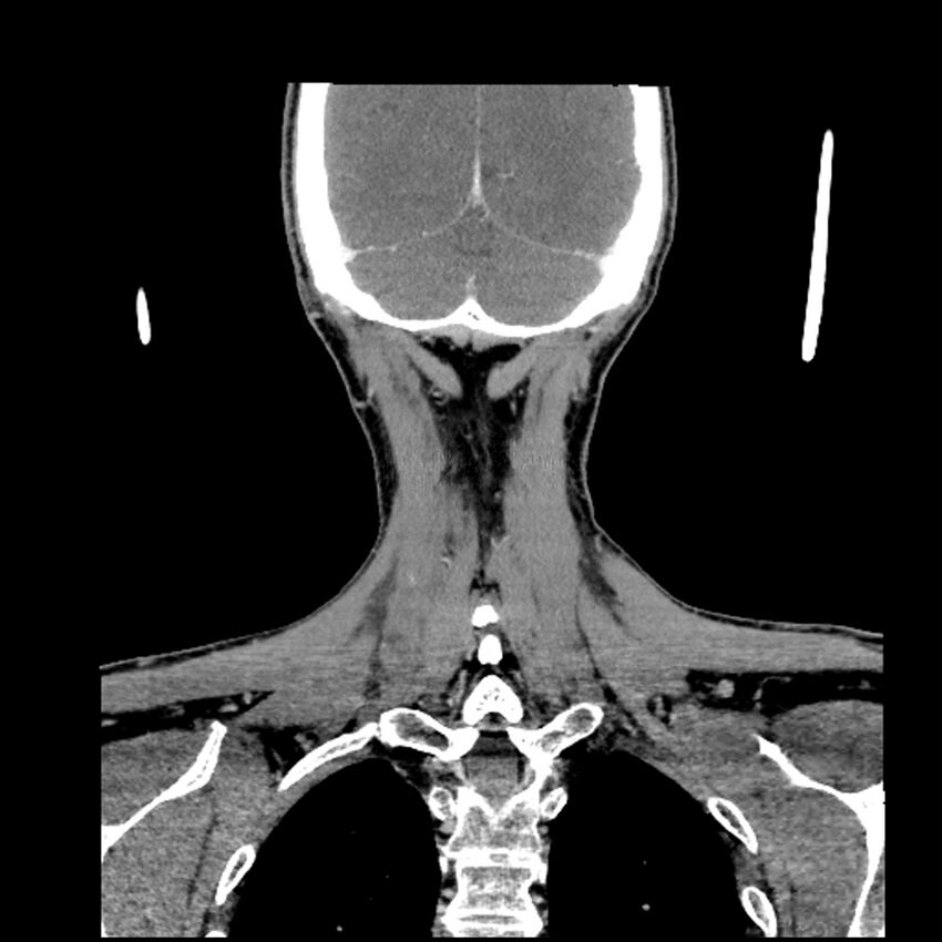 Anaplastic thyroid carcinoma (Radiopaedia 79087-92034 A 97).jpg