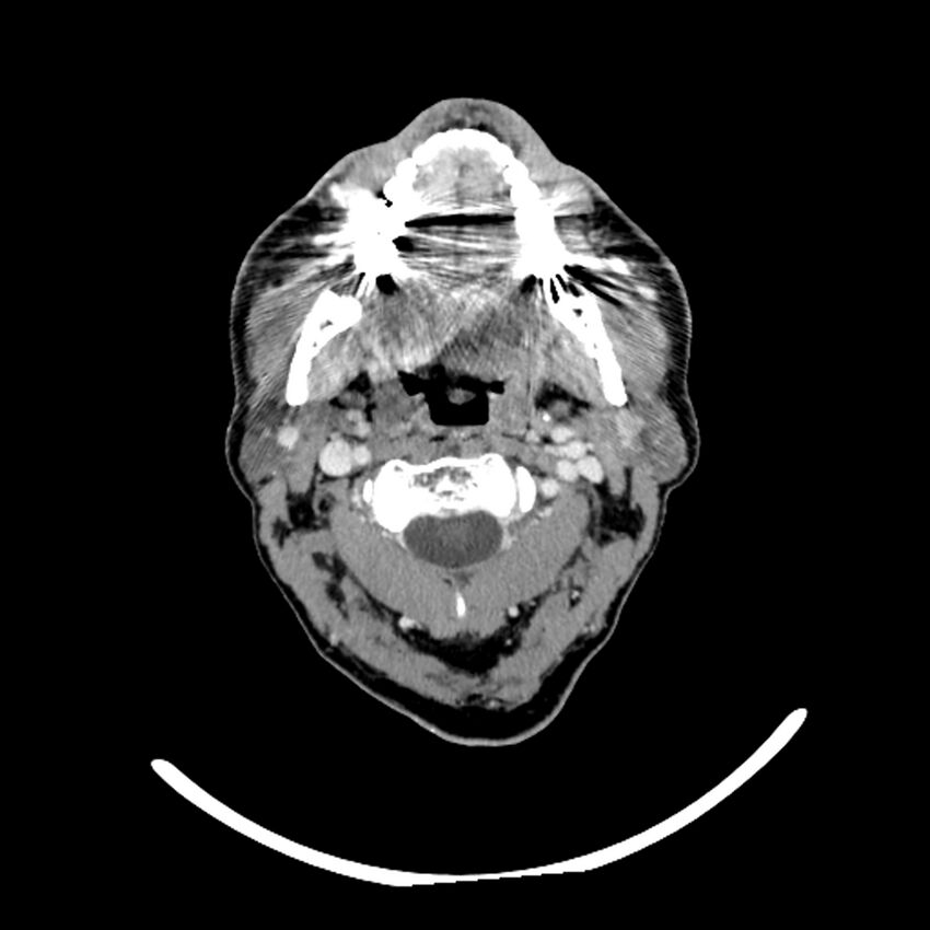 Anaplastic thyroid carcinoma (Radiopaedia 79087-92034 B 95).jpg