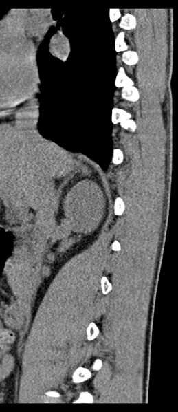 File:Aneurysmal bone cyst T11 (Radiopaedia 29294-29721 E 60).jpg