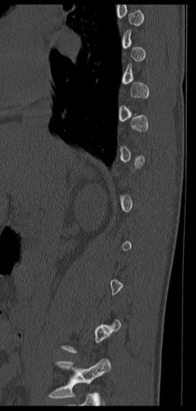 File:Aneurysmal bone cyst T11 (Radiopaedia 29294-29721 Sagittal bone window 57).jpg