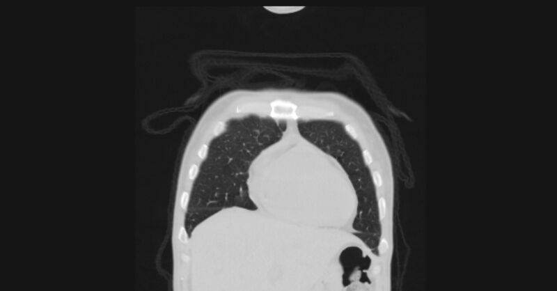 File:Angioinvasive aspergellosis (Radiopaedia 66995-76315 Coronal lung window 9).jpg