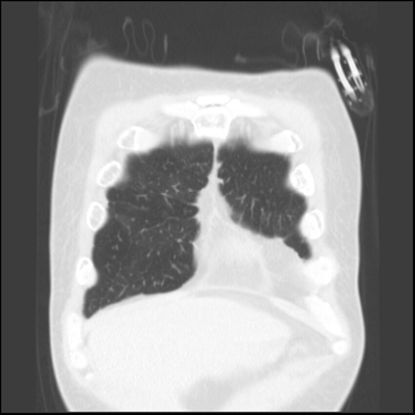 Angioinvasive aspergillosis (Radiopaedia 43957-47466 Coronal lung window 81).jpg