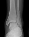 Ankle (distal fibular) fracture - Weber C (Radiopaedia 36043).jpg