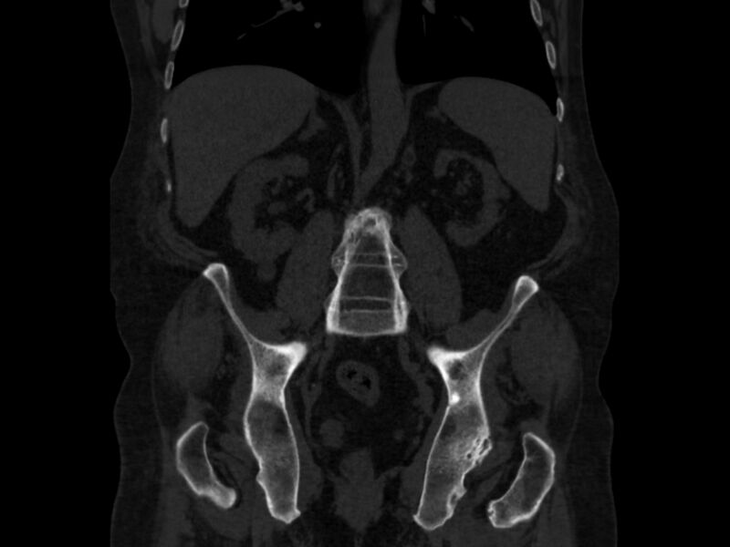 File:Ankylosing spondylitis (Radiopaedia 44609-48357 Coronal bone window 47).jpg