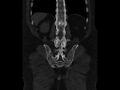 Ankylosing spondylitis (Radiopaedia 44609-48357 Coronal bone window 77).jpg