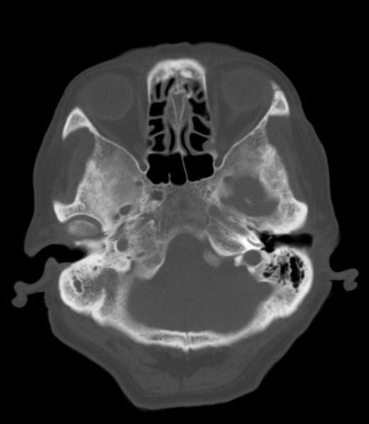 File:Anomalous intracranial venous drainage (Radiopaedia 28161-28418 Axial 9).png