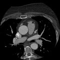 Anomalous origin of left circumflex artery from right coronary sinus (Radiopaedia 72563-83117 B 19).jpg
