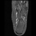 Anterior calcaneal process fracture (Radiopaedia 74654-85611 Axial PD fat sat 23).jpg