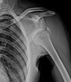 Anterior dislocation of shoulder with fracture of greater tuberosity (Radiopaedia 35320).jpg