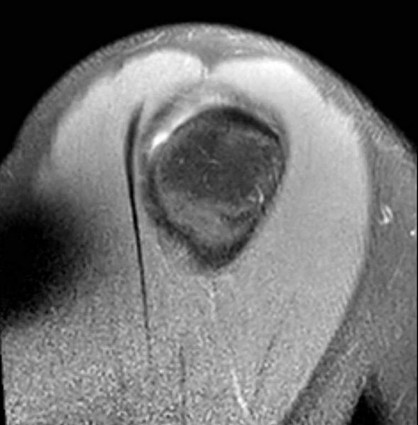 File:Anterior labral tear- extensive (Radiopaedia 73682-84476 Sagittal T2 fat sat 5).jpg