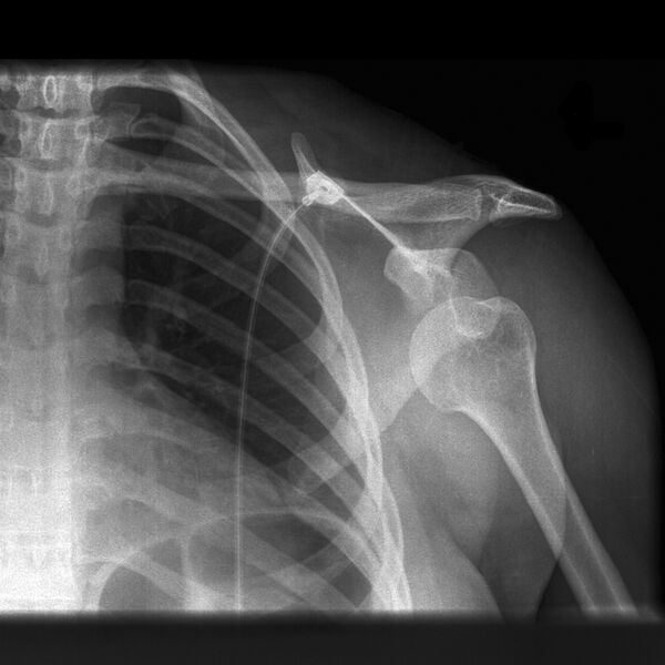 File:Anterior shoulder dislocation (Radiopaedia 10983-11401 Frontal 1).jpg