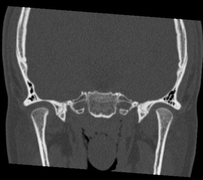 File:Antrochoanal polyp (Radiopaedia 21894-21868 Coronal bone window 35).jpg