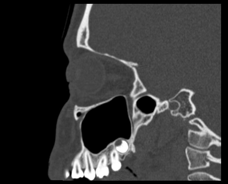 File:Antrochoanal polyp (Radiopaedia 21894-21868 Sagittal bone window 31).jpg