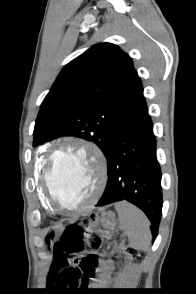 File:Aortic coarctation with aneurysm (Radiopaedia 74818-85828 B 131).jpg