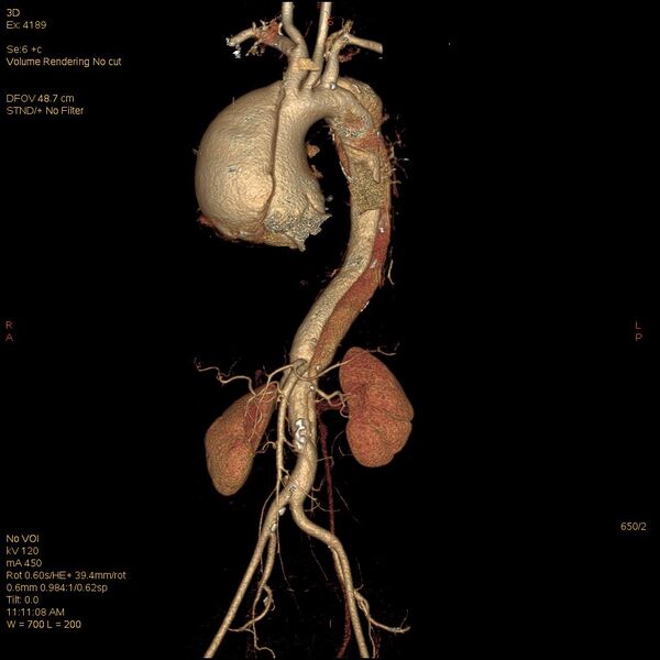 File:Aortic dissection (Radiopaedia 25350-25604 E 2).jpg
