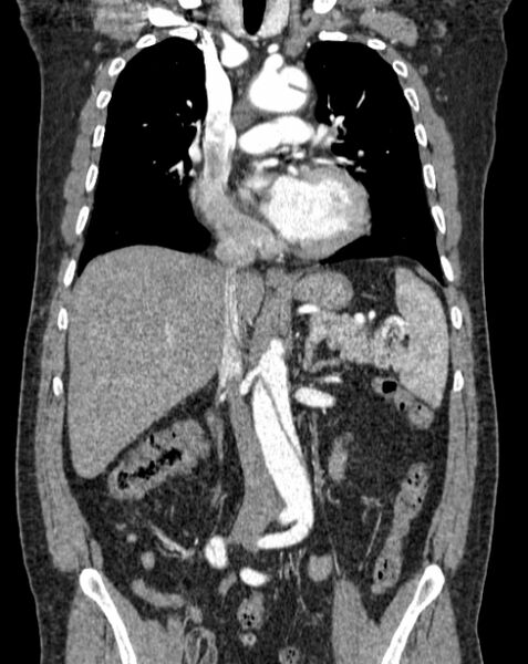 File:Aortic dissection (Radiopaedia 44411-48061 A 22).jpg