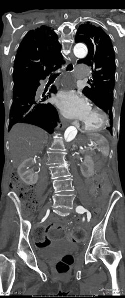 File:Aortic dissection with extension into aortic arch branches (Radiopaedia 64402-73204 A 45).jpg