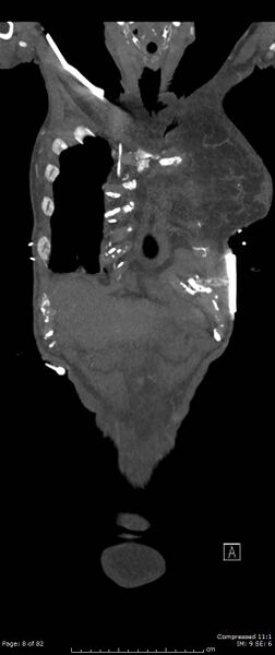 File:Aortic dissection with extension into aortic arch branches (Radiopaedia 64402-73204 A 8).jpg