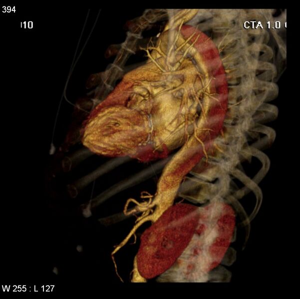 File:Aortic dissection with rupture into pericardium (Radiopaedia 12384-12647 C+ arterial phase 26).jpg