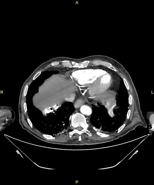 File:Aortoenteric fistula (Radiopaedia 84308-99603 B 13).jpg