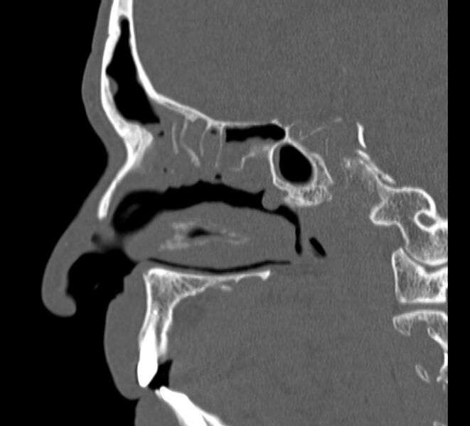 File:Aplastic maxillary sinuses (Radiopaedia 60030-67561 Sagittal bone window 19).jpg