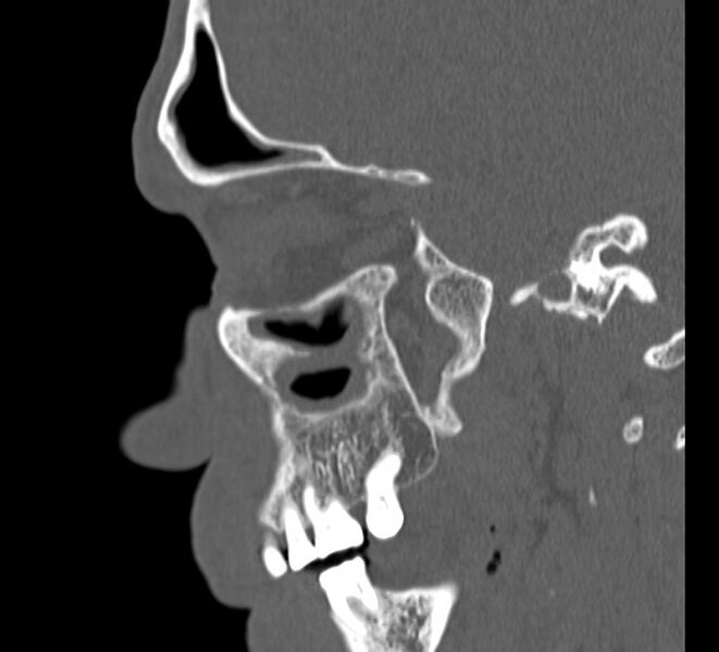 File:Aplastic maxillary sinuses (Radiopaedia 60030-67561 Sagittal bone window 23).jpg