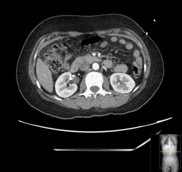 File:Appendicitis (CT angiogram) (Radiopaedia 154713-127660 Axial 111).jpg