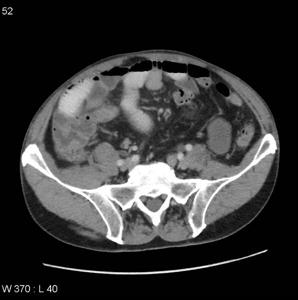 File:Appendicitis (Radiopaedia 27446-27642 A 31).jpg