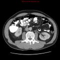 Appendicitis and renal cell carcinoma (Radiopaedia 17063-16760 A 28).jpg