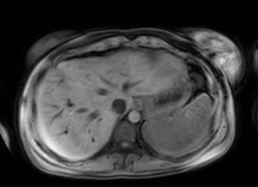Appendicitis in gravida (MRI) (Radiopaedia 89433-106395 Axial DIXON 10).jpg